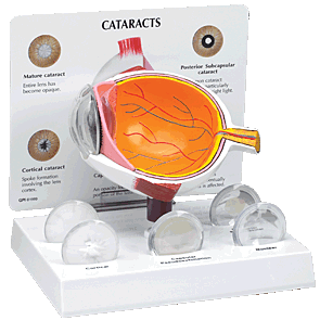 Eye Model, Cataract