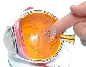 Eye Model - Detachment, mounted with clear film on the back.  Used to help illustrate retinal detachment. (was 15163)